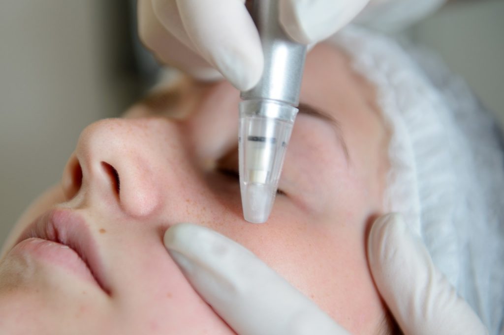 Microdermabrasion facial rotorua
